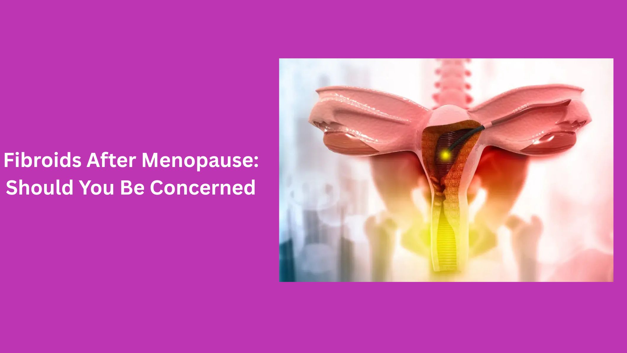 fibroids-after-menopause-should-you-be-concerned