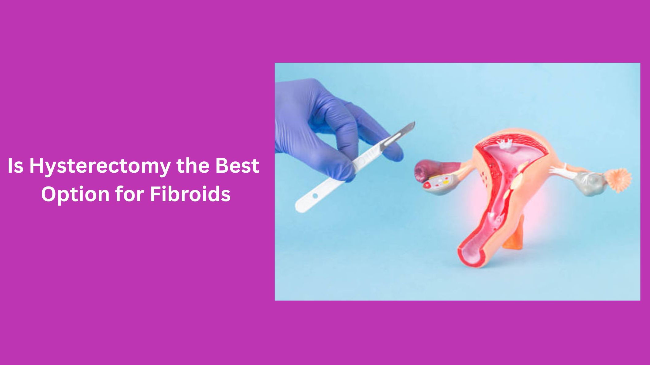 is-hysterectomy-the-best-option-for-fibroids