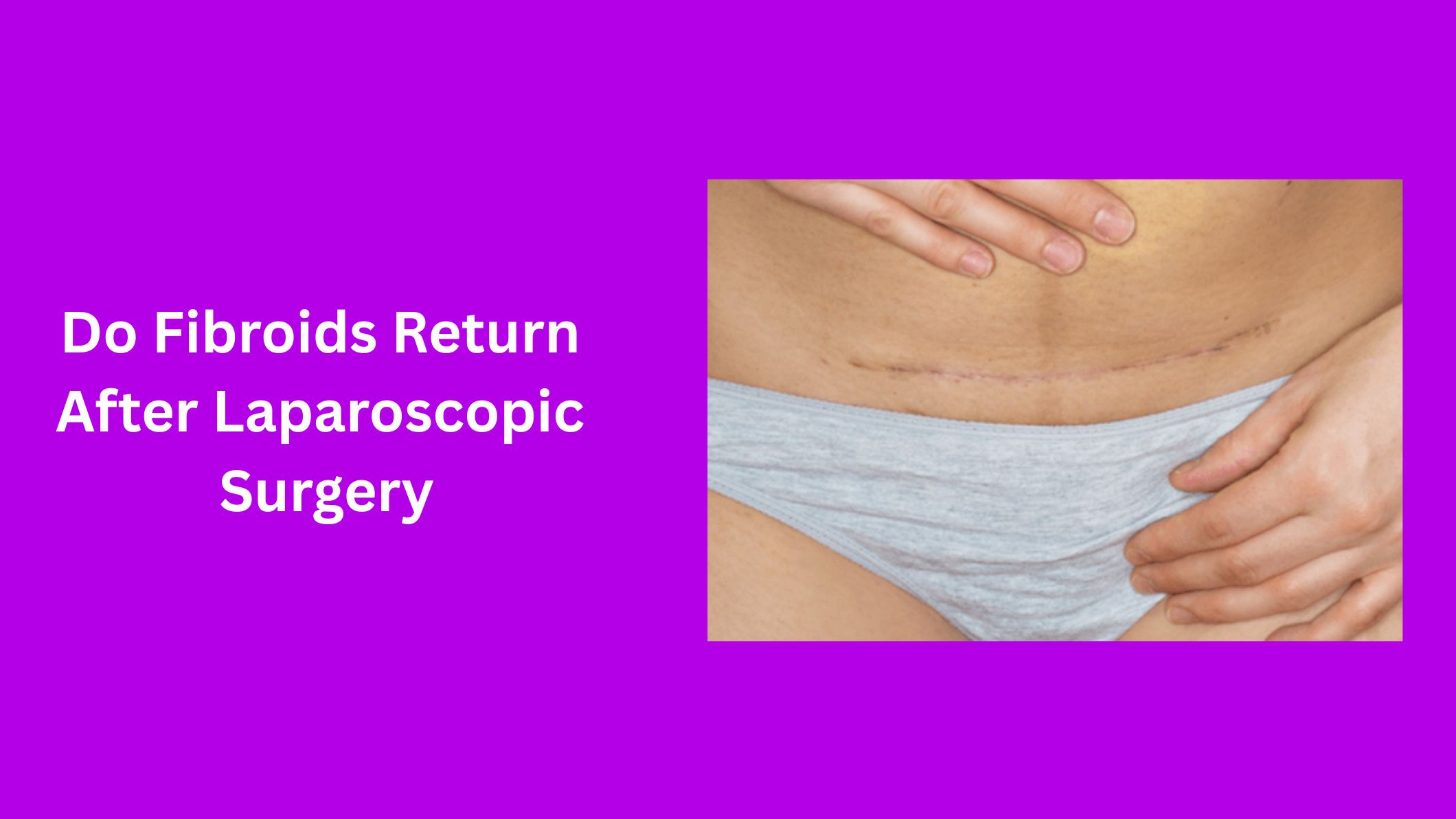 do-fibroids-return-after-laproscopic-surgery