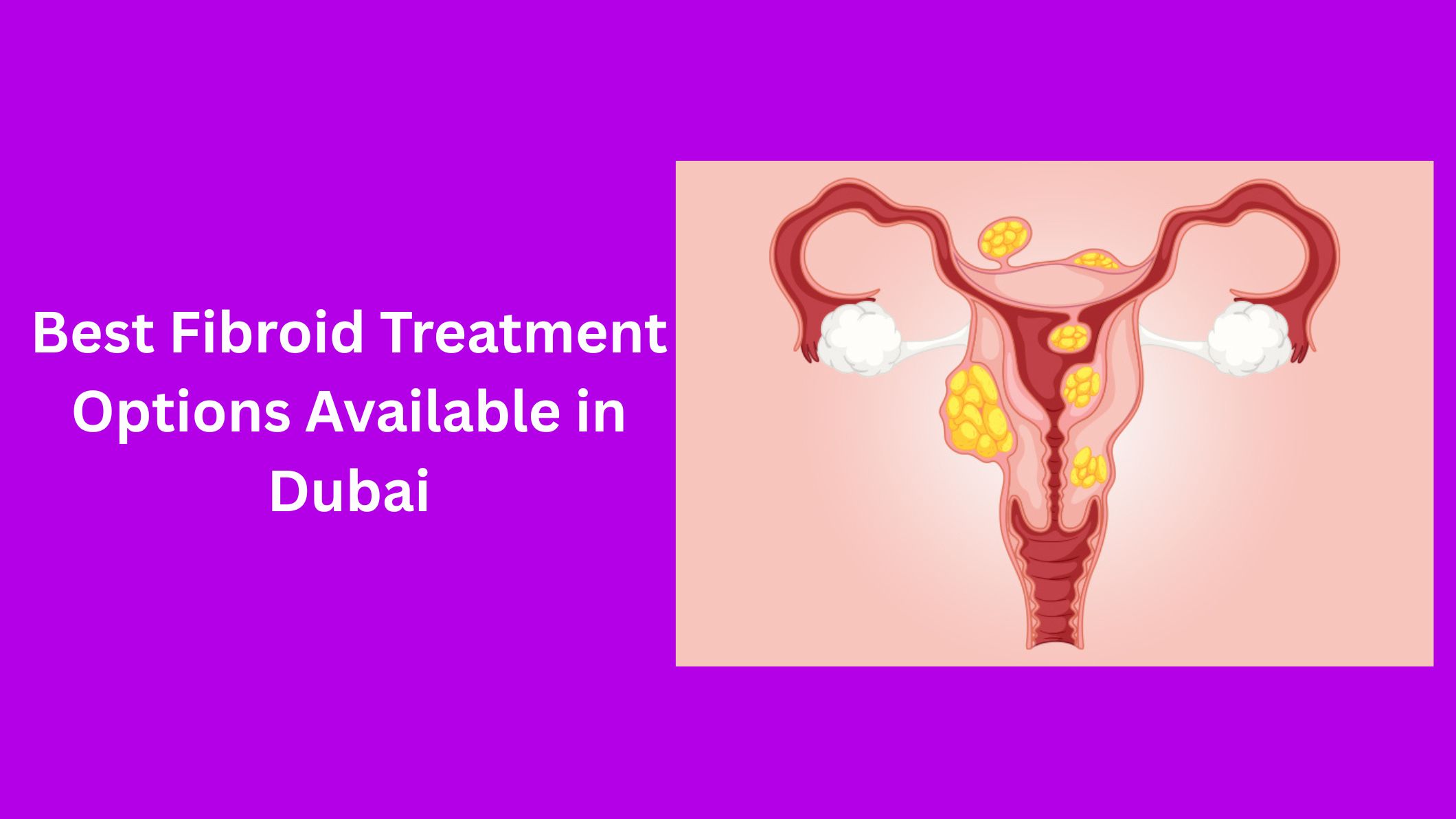 best-fibroid-treatment-options-available-in-dubai