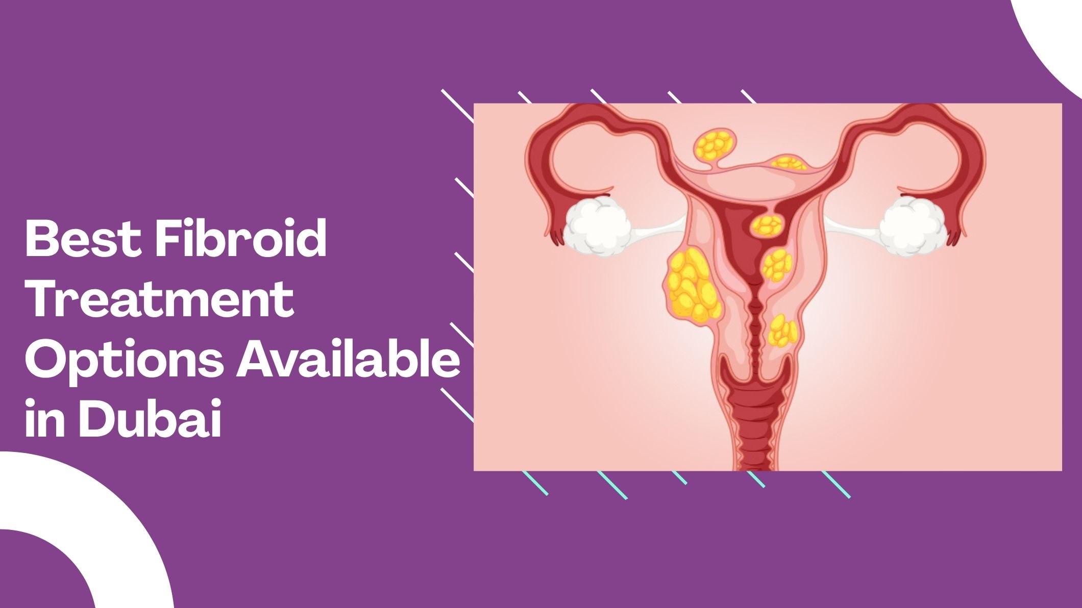 best-fibroid-treatment-options-available-in-dubai