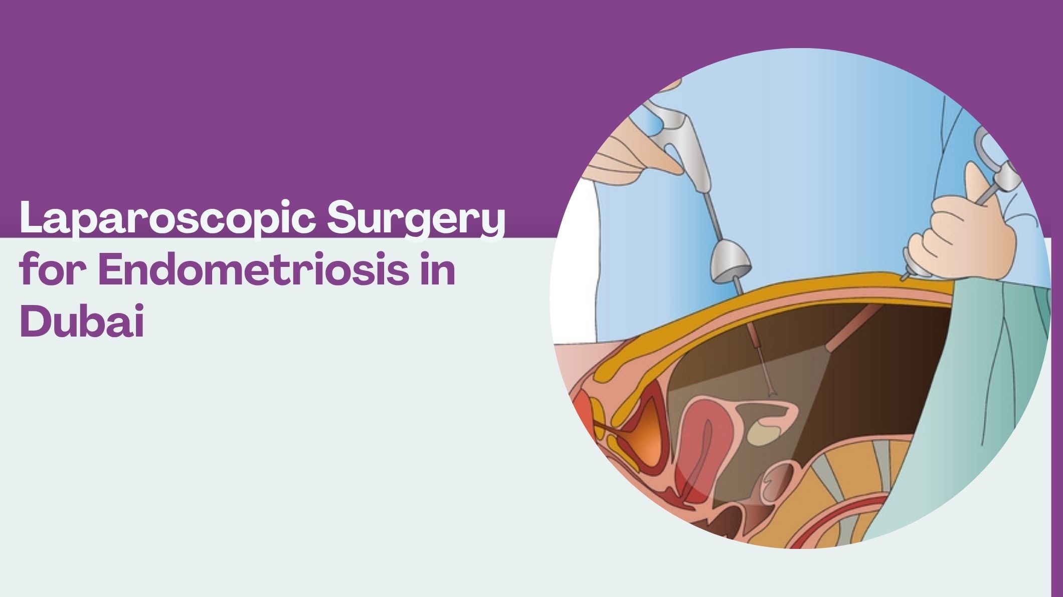 laparoscopic-surgery-for-endometriosis-in-dubai