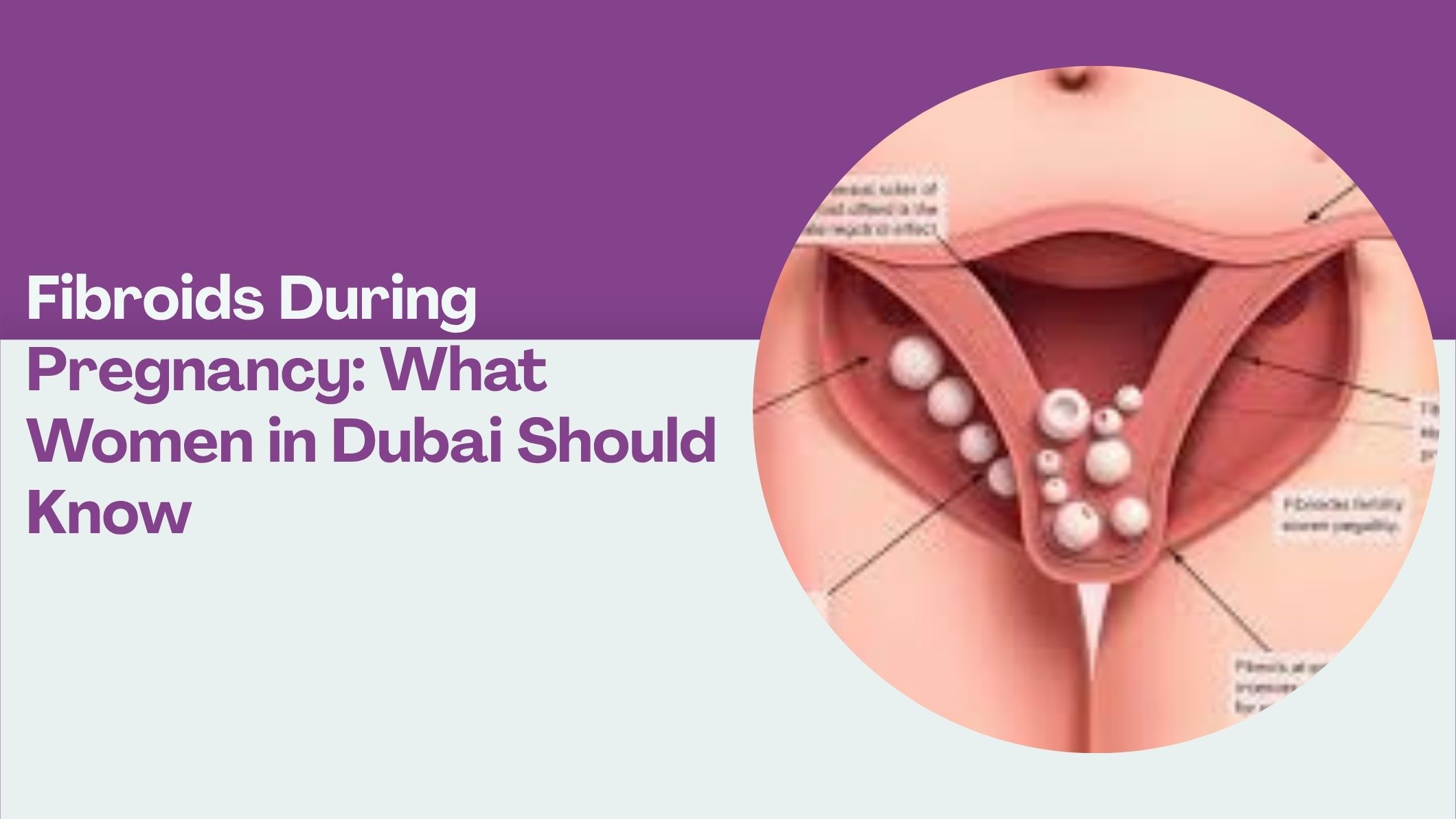 fibroids-during-pregnancy-what-women-in-dubai-should-know