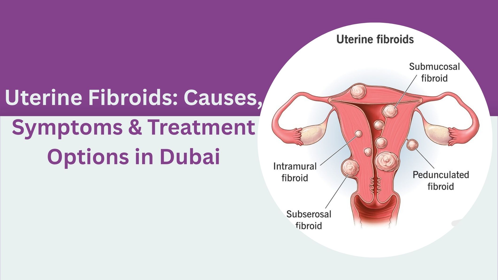uterine-fibroids-causes-symptoms-and-treatment-options-in-dubai