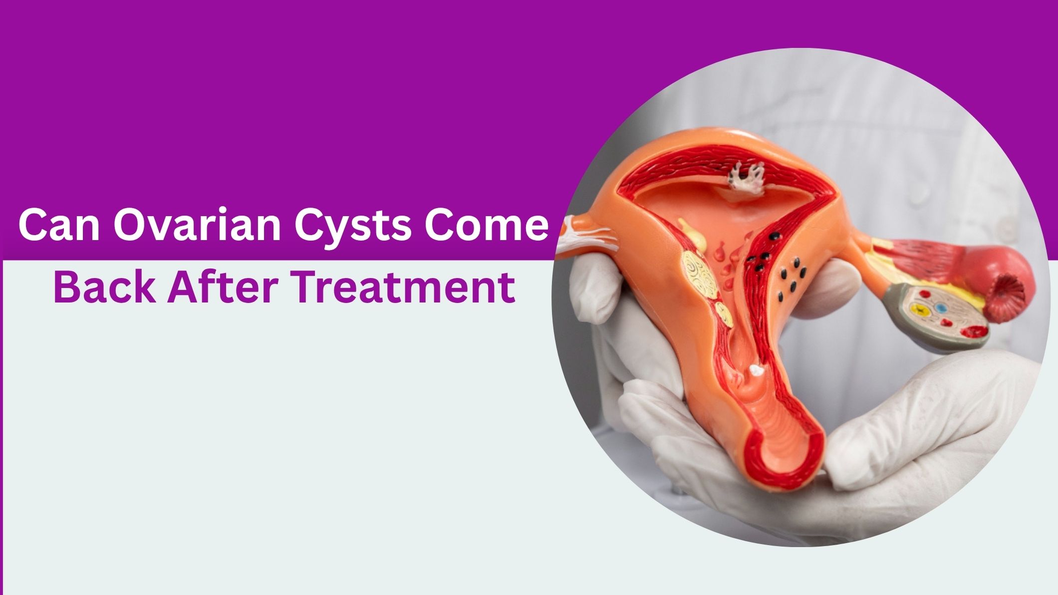 can-ovarian-cysts-come-back-after-treatment