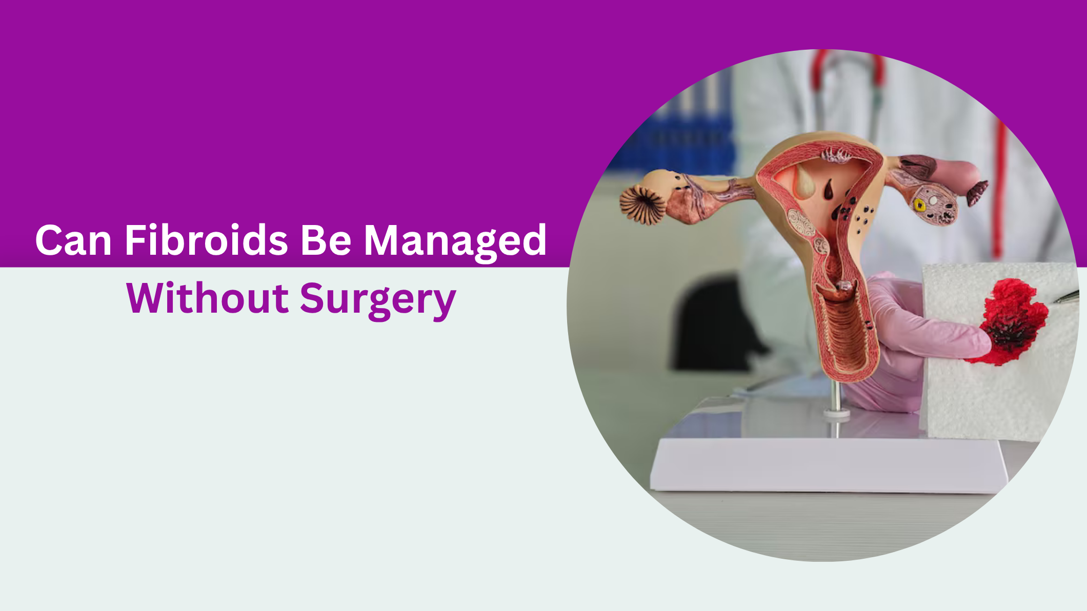 can-fibroids-be-managed-without-surgery