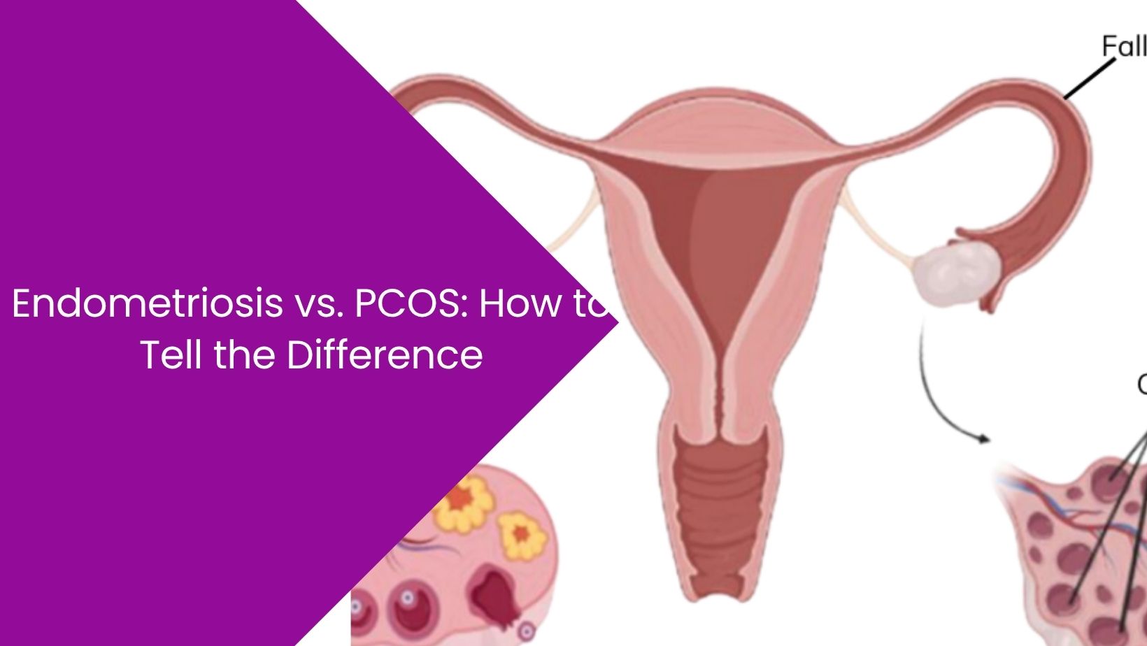 Endometriosis vs. PCOS: How to Tell the Difference endometriosis-vs-PCOS-how-to-tell-the-difference