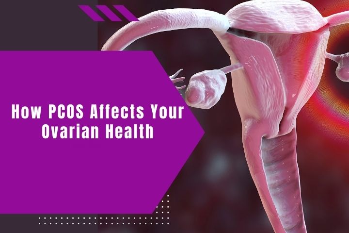 how-pcos-affects-your-ovarian-health