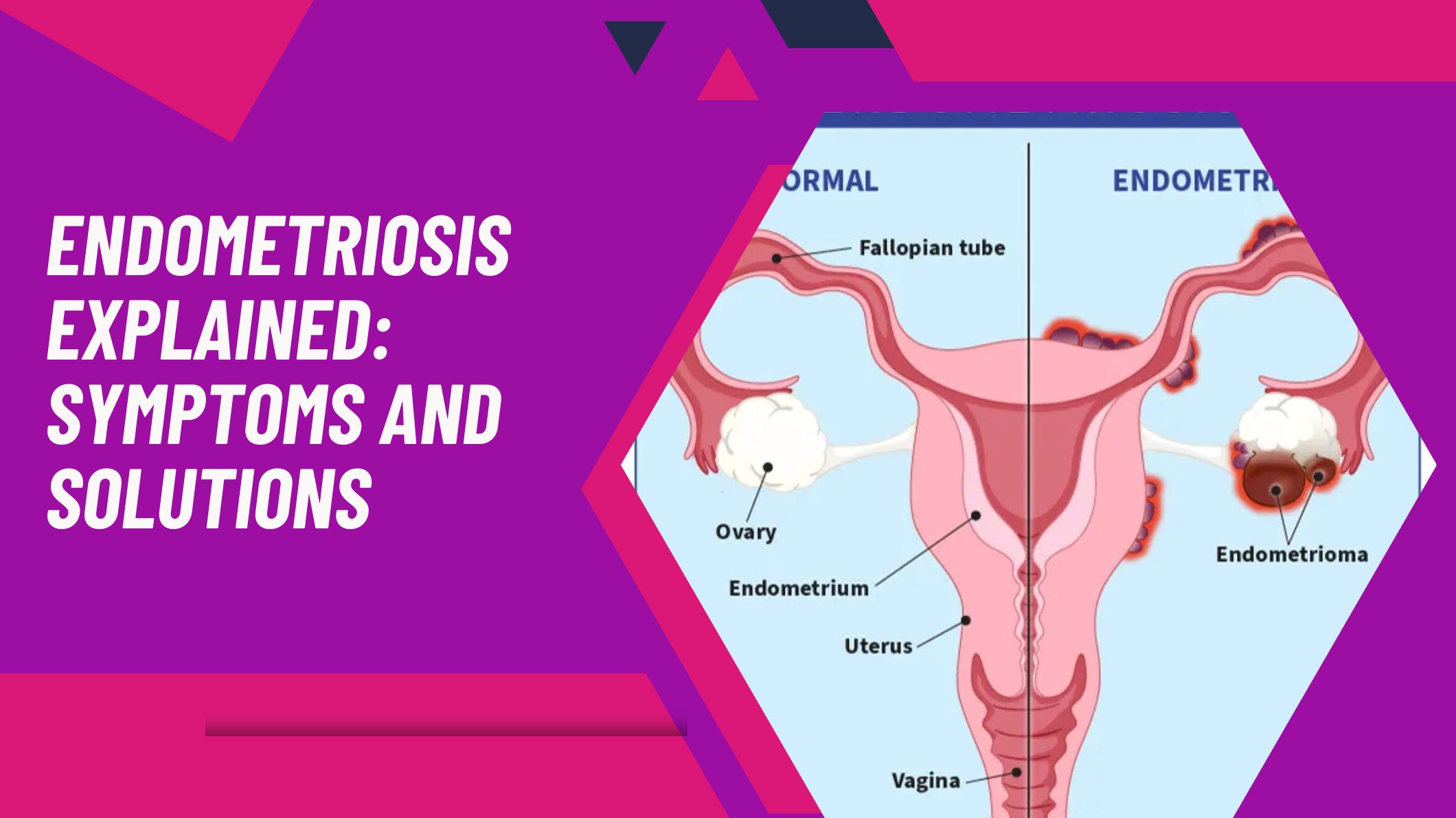Endometriosis Explained: Symptoms and Solutions endometriosis-explained-symptoms-and-solutions
