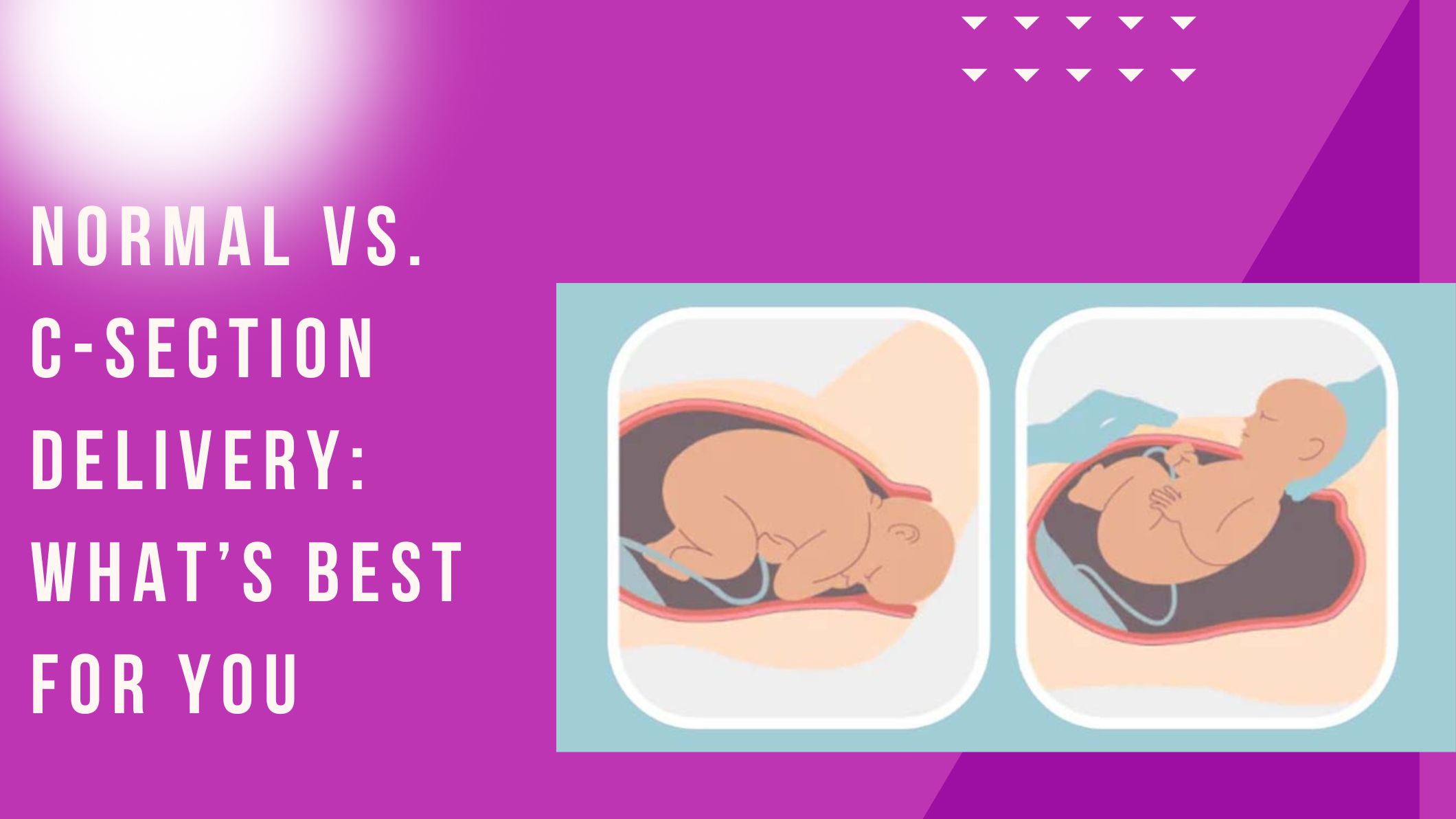 normal-vs-c-section-delivery-whats-best-for-you