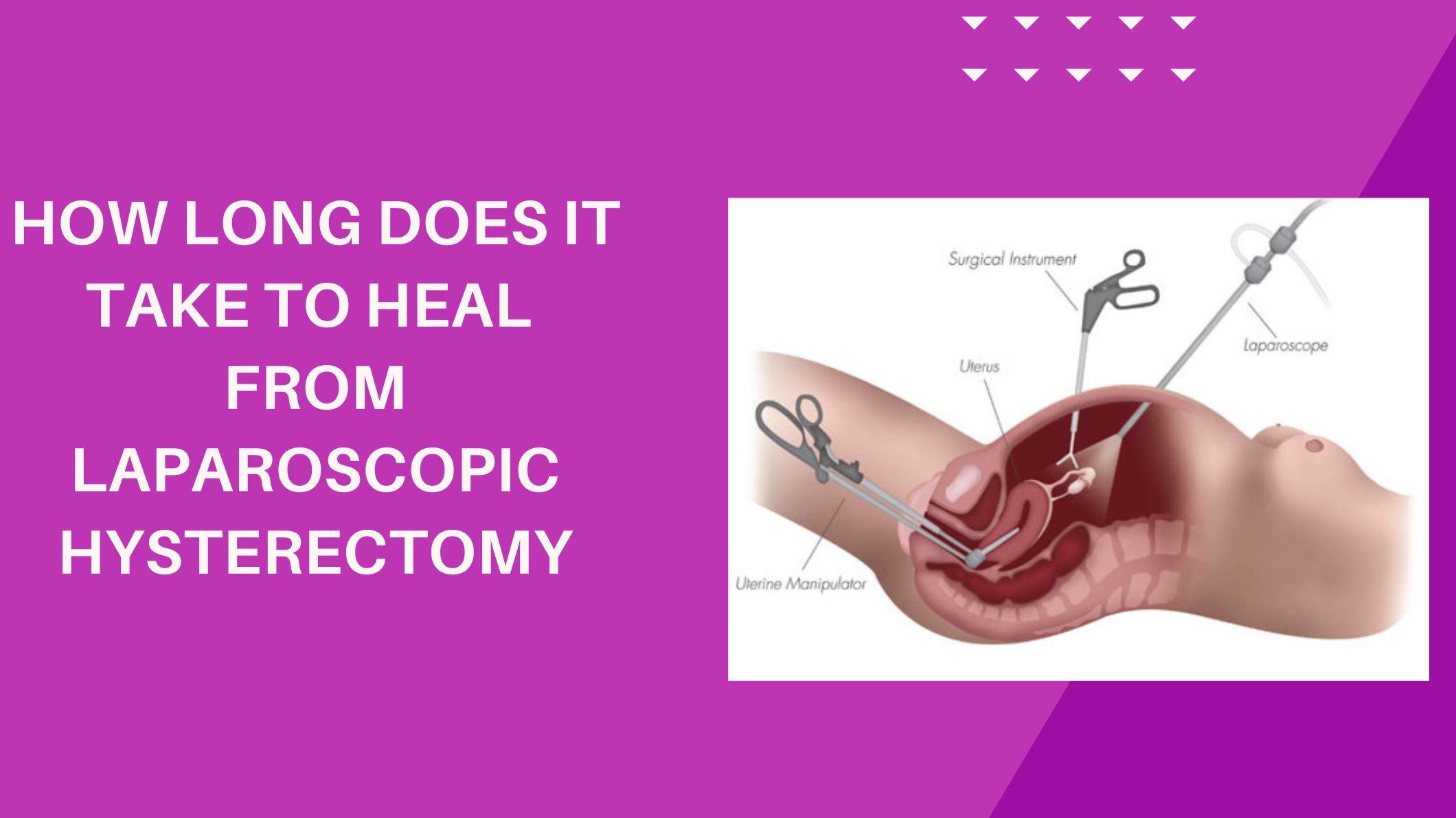 how-long-does-it-take-to-heal-from-laparoscopic-hysterectomy