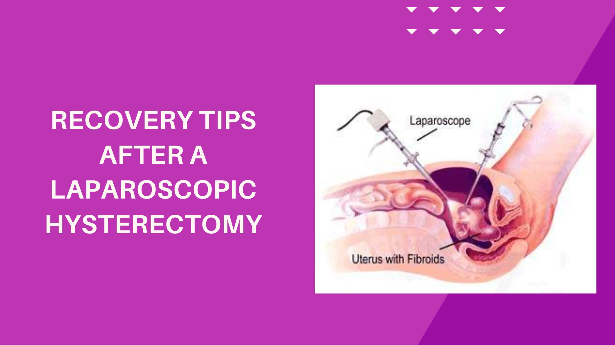 recovery-tips-after-a-laparoscopic-hysterectomy