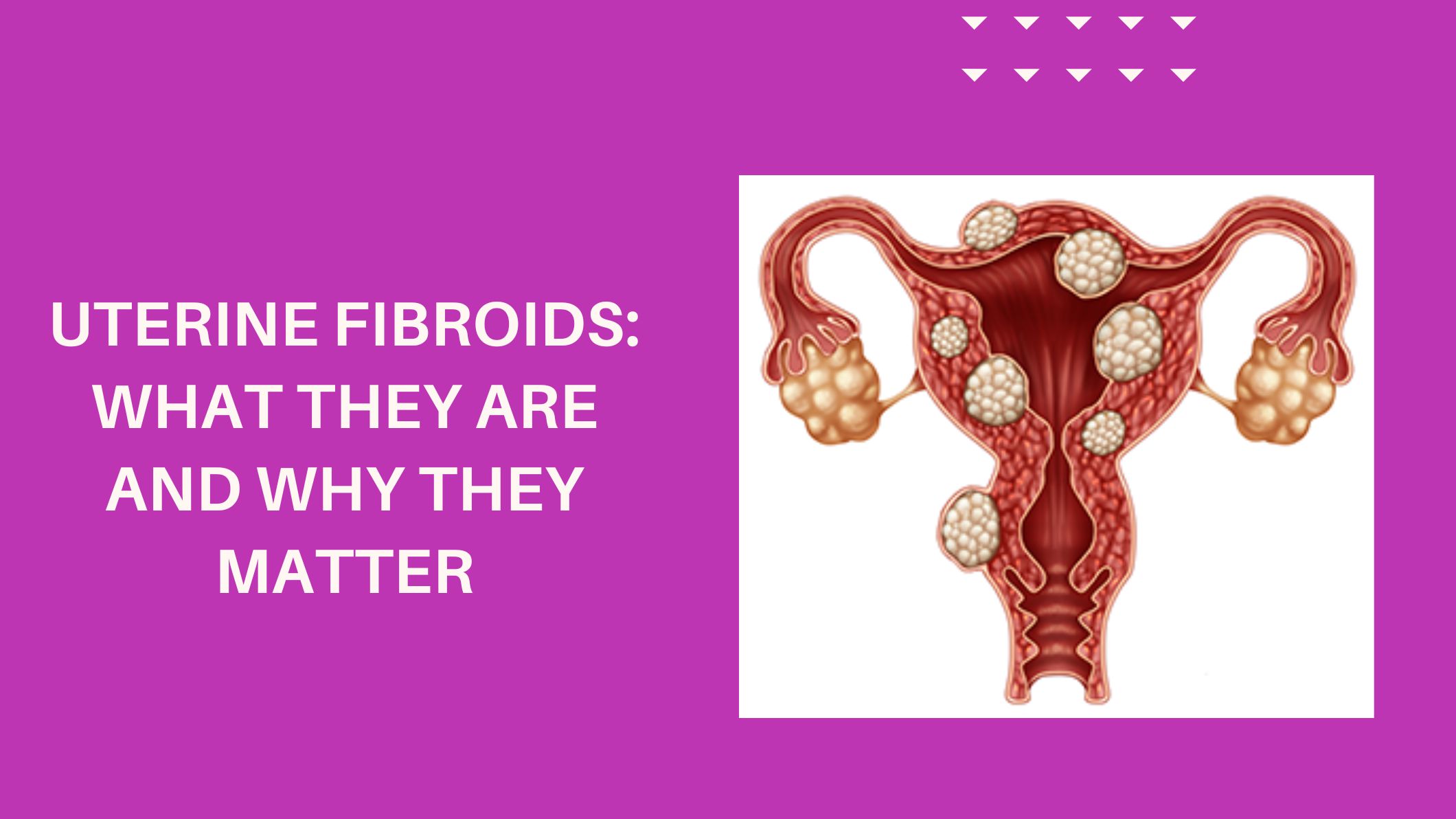 uterine-fibroids-what-they-are-and-why-they-matter