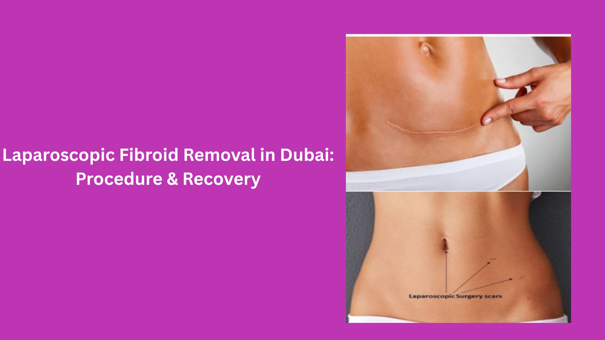 laparoscopic-fibroid-removal-in-dubai-procedure-and-recovery